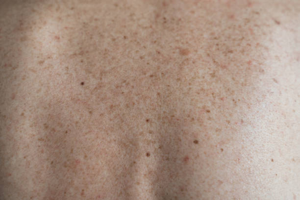 Melasma